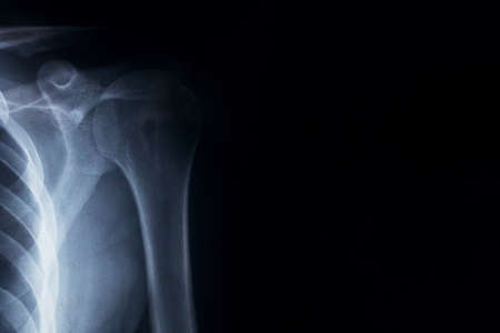 X-ray of the shoulder on black background with copy spaceの写真素材
