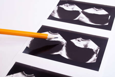 Image of an ultrasound scan of the prostate close upの写真素材