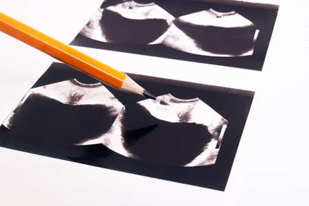 Image of an ultrasound scan of the prostate close upの写真素材