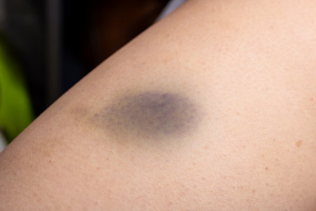 A close up of a person's arm with a purple spot on itの写真素材