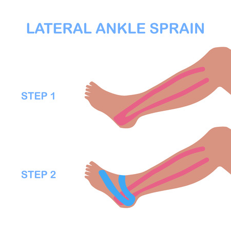 Lateral ankle sprain. Correct kinesiology taping. Vector illustration.のイラスト素材