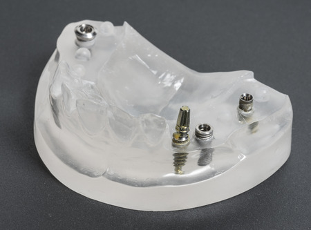 dental implants in dental model