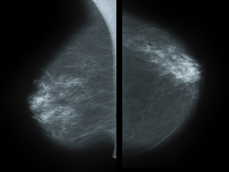 a Mammography picture - x-ray of Breastの写真素材