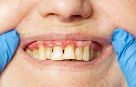 teeth with periodontitis close upの写真素材