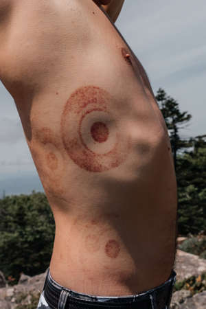 Close-up of skin after traditional cupping or vacuum therapy. Image with copy space. Bruise on the body. high quality photoの写真素材