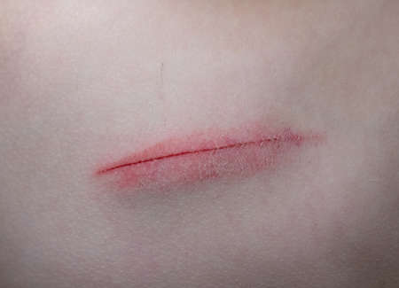 Skin abrasion or scratch on the abdomen. Medical abrasion, injury or wound High quality photoの写真素材