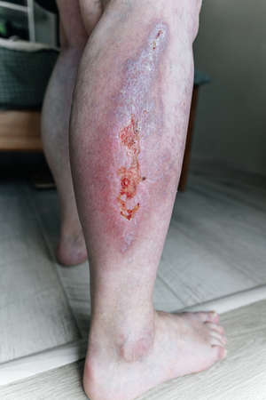Large healing wound on the lower leg with scars, redness, scarring of the skin, the concept of human tissue regeneration. high quality photoの写真素材