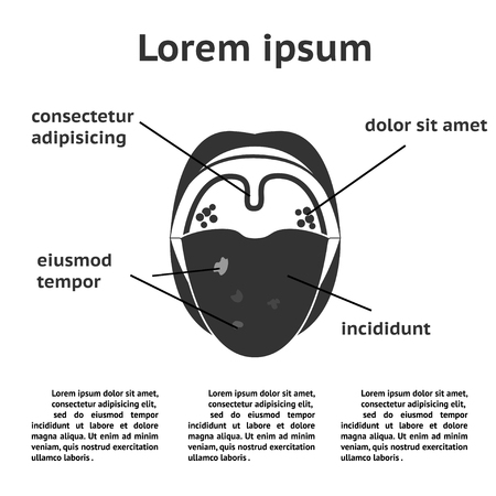 Tonsillitis bacterial. Angina, pharyngitis and tonsillitis. Infection of tonsils caused by virus or bacteria. Recurring and persistent infection of tonsils.のイラスト素材
