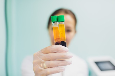 Preparing for Plasmolifting. Blood tubes in two layers divided by centrifuge after. cosmetic manipulation.の写真素材