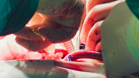 The process of cardiac surgery. The heart surgery.