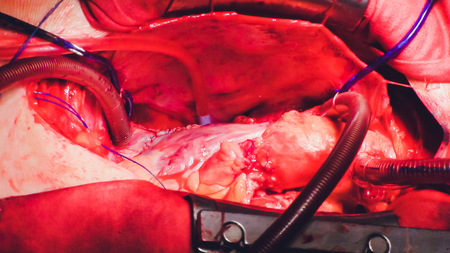 The process of cardiac surgery. The heart surgery.の写真素材