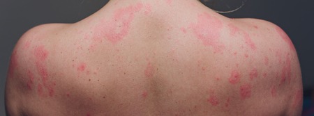 Close up Allergy rash, Around Back view of human with dermatitis problem of rash ,Allergy rash and...
