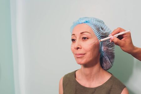 Aged woman doing mesothreads and Thread Lifting, Cosmetology. Cosmetic procedure to eliminate signs of aging. Beauty Face, Facial contour, plastic surgery concept for Age 40-50 years.の写真素材