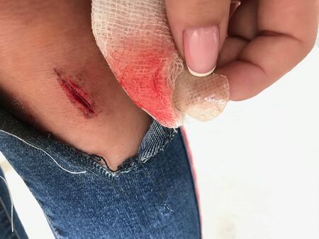 close up of cut wound at leg. health care concepts.の写真素材
