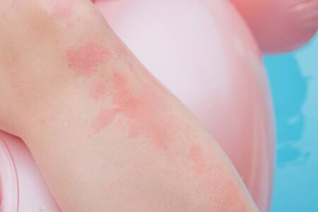 Dermatitis Herpetiformis skin rash in a woman with Nonceliac Gluten Sensitivity. Serum antibodies positive to wheat and gluten. Colonoscopy and upper endoscopy negative for celiac diseaseの写真素材