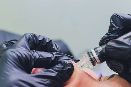 Woman cleaning nose skin pores using vacuum blackhead remover, cosmetic procedure.の写真素材