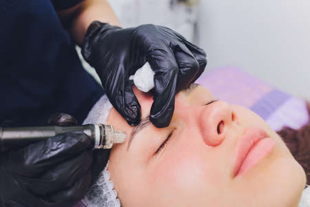 Dermabrasion girls forehead. Instrumental cosmetology. Spa. Facial Rejuvenation. Mechanical peeling skin.の写真素材