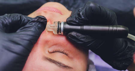 Woman cleaning nose skin pores using vacuum blackhead remover, cosmetic procedure.の写真素材