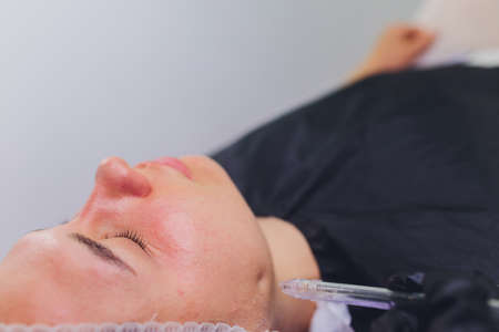 Woman cleaning nose skin pores using vacuum blackhead remover, cosmetic procedure.の写真素材