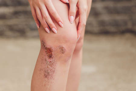 two scratch wound on female knee with big scar closeup, healthcare and medicine concept.の写真素材