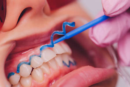 Close-up portrait of a female patient visiting dentist for teeth whitening in clinic,Teeth whitening...