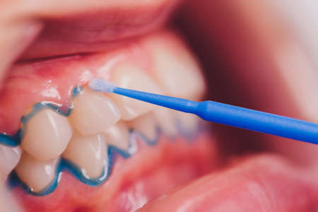 Close-up portrait of a female patient visiting dentist for teeth whitening in clinic,Teeth whitening procedure.の写真素材