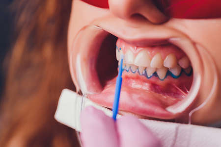 Close-up portrait of a female patient visiting dentist for teeth whitening in clinic,Teeth whitening procedure.の写真素材