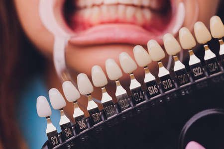 The dentist comparing patients teeth shade with samples for bleaching treatment.の写真素材
