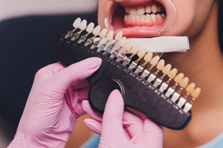The dentist comparing patients teeth shade with samples for bleaching treatment.の写真素材