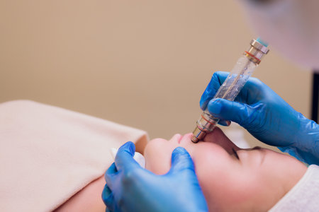 Woman cleaning skin pores using vacuum blackhead remover, cosmetic procedure.の写真素材