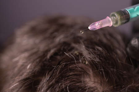 Mesotherapy for hair. Attractive man receiving injections in his head. Man having mesotherapy session at beauty salon, therapist in protective glove with syringe,の写真素材