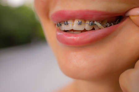 Beautiful young woman with brackets on teeth close up.