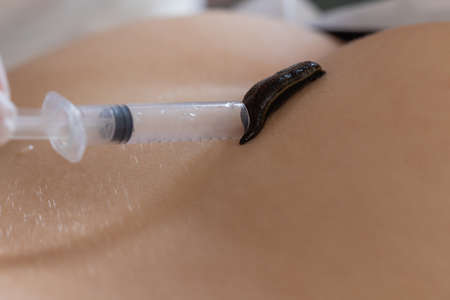 Traditional alternative medicine - doctor doing procedure of hirudotherapy for young woman.の写真素材