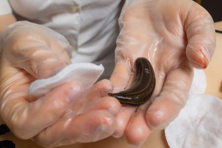 Traditional alternative medicine - doctor doing procedure of hirudotherapy for young woman.