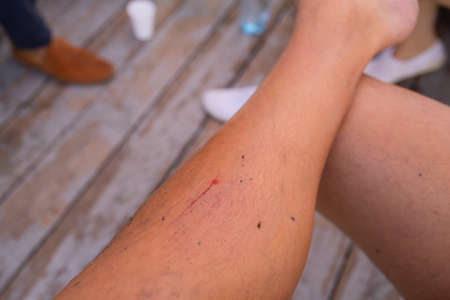scratch lesion caused by the accident on leg skin.の写真素材