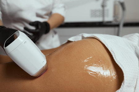 Young African woman getting laser hair removal on her thighs.の写真素材