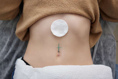 Close up of skin held in piercing tool as needle is ready to go in to pierce naval.の写真素材