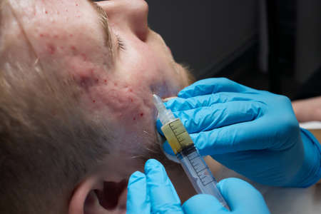Injection at spa salon. Doctor hands in gloves. Closeup. Pretty male patient. Beauty treatment....
