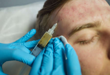 Injection at spa salon. Doctor hands in gloves. Closeup. Pretty male patient. Beauty treatment. Healthy skin procedure. Young man face. Plasmolifting rejuvenation.の写真素材