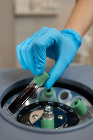 Beautician doctors hands put test tube with blood in centrifuge container. Rejuvenation...