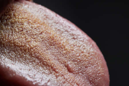 tongue with ulcers of adult man.Cracks in the tongue of a young man.man with halitosis for candida albicans on tongue.の写真素材