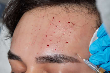 Injection at spa salon. Doctor hands in gloves. Closeup. Pretty male patient. Beauty treatment....