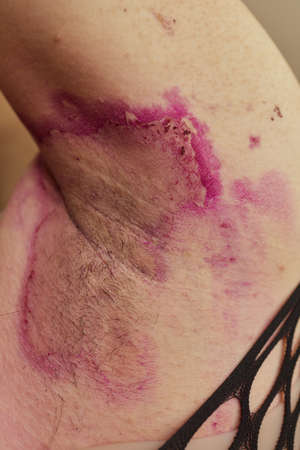 Affected skin, Armpit Underarm Rash infections ringworm, bacterial folliculitis, hidradenitis...