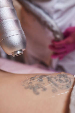 Young woman undergoing laser tattoo removal procedure in salon, closeup.