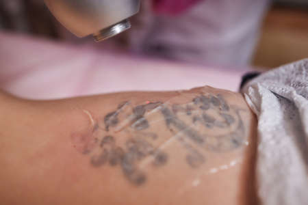 Young woman undergoing laser tattoo removal procedure in salon, closeup.の写真素材