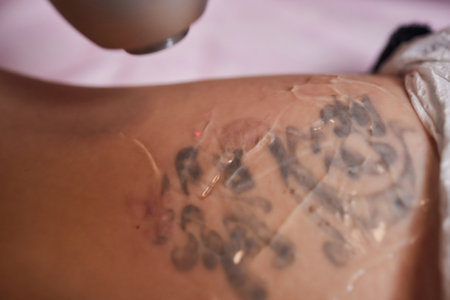 Young woman undergoing laser tattoo removal procedure in salon, closeup.の写真素材