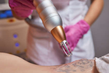 Young woman undergoing laser tattoo removal procedure in salon, closeup.