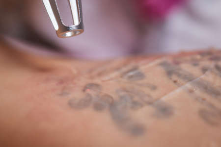 Young woman undergoing laser tattoo removal procedure in salon, closeup.