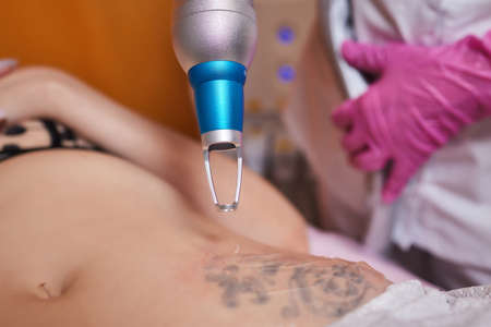Young woman undergoing laser tattoo removal procedure in salon, closeup.の写真素材