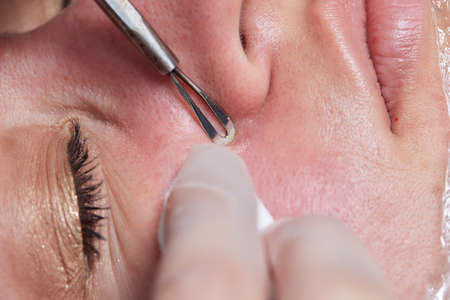 Mechanical facial cleansing, skin cleansing procedure from surface and deep impurities. new.の写真素材